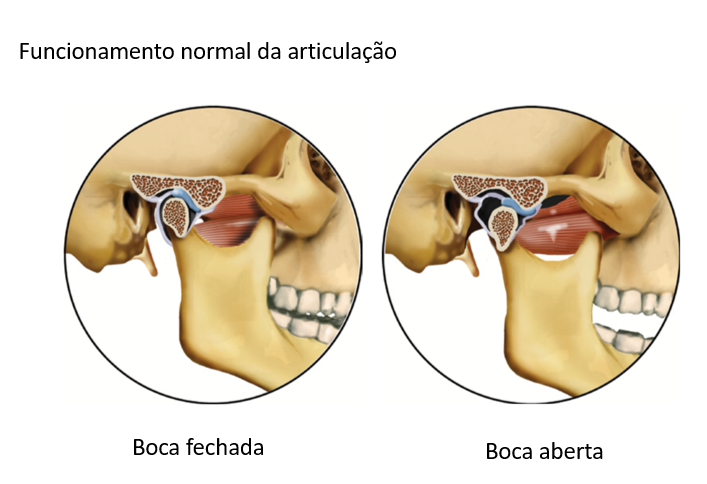 Clínica Statto - A Articulação Temporomandibular (ATM) funciona como uma  dobradiça que liga a Mandíbula ao crânio. Esta disfunção pode causar dor e  desconforto. Dores no maxilar, dificuldade de mastigar e estalos